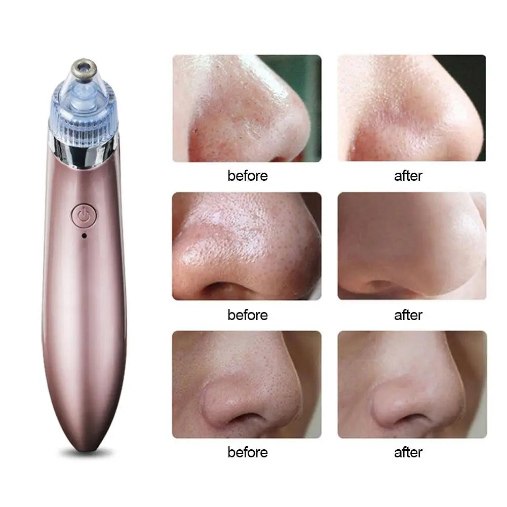 Blackhead Remover Pore Acne Pimple Removal Vacuum Suction blackheadrem